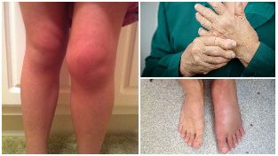 the consequences of osteoarthritis
