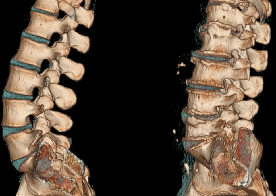 Osteochondrosis