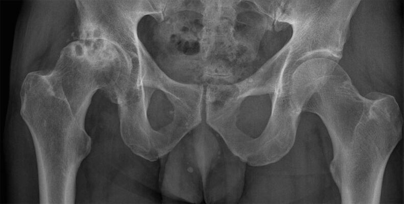X-ray of deforming arthrosis of the hip joint