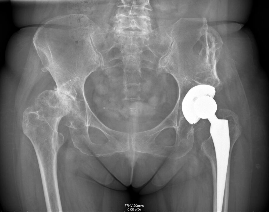 X-ray of the hip joint after endoprosthetics