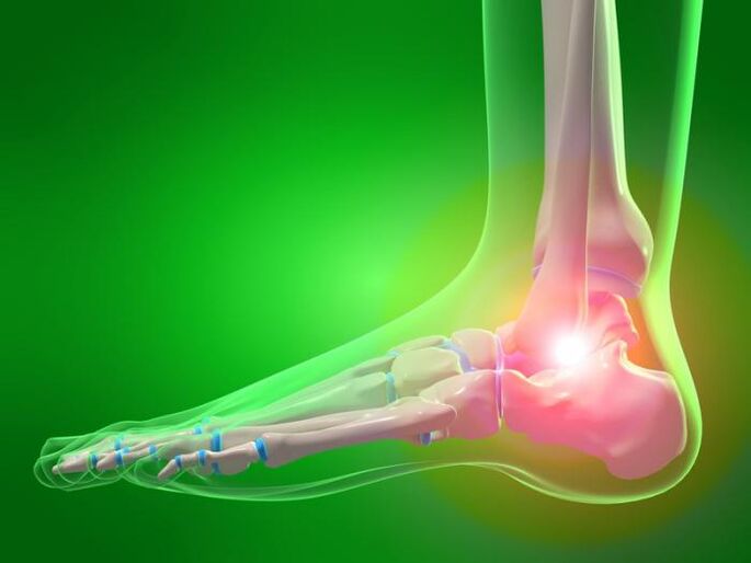 Inflammation of the ankle with arthrosis