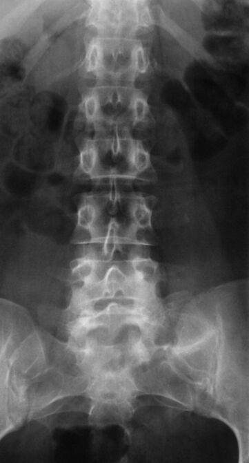 To diagnose lumbar osteochondrosis, an x-ray is performed