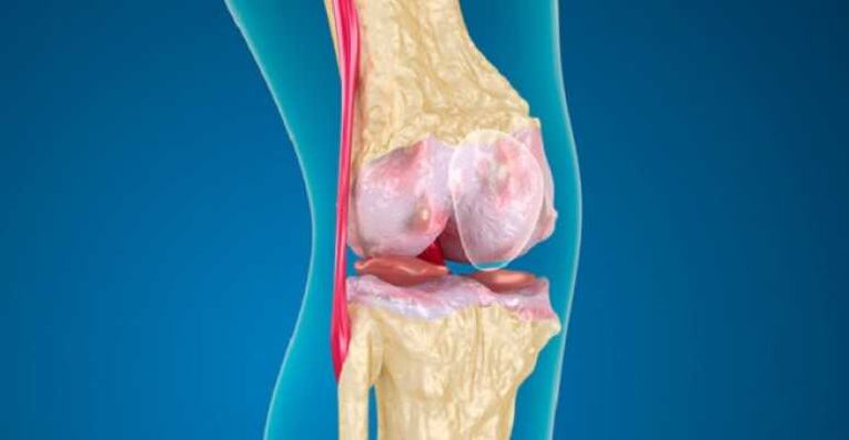 Arthrosis of the knee disease, which causes the destruction of cartilage in the joints