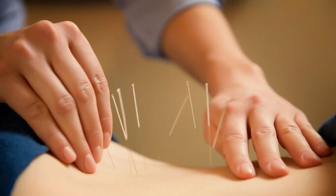 Acupuncture to treat back pain