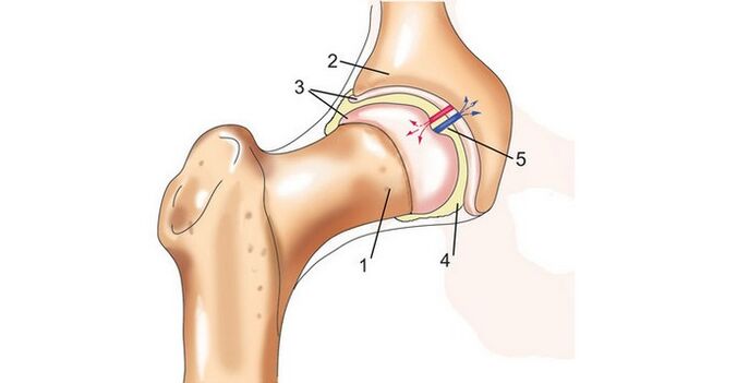 Hip joint and osteoarthritis