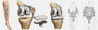 Arthroplasty using the example of the knee